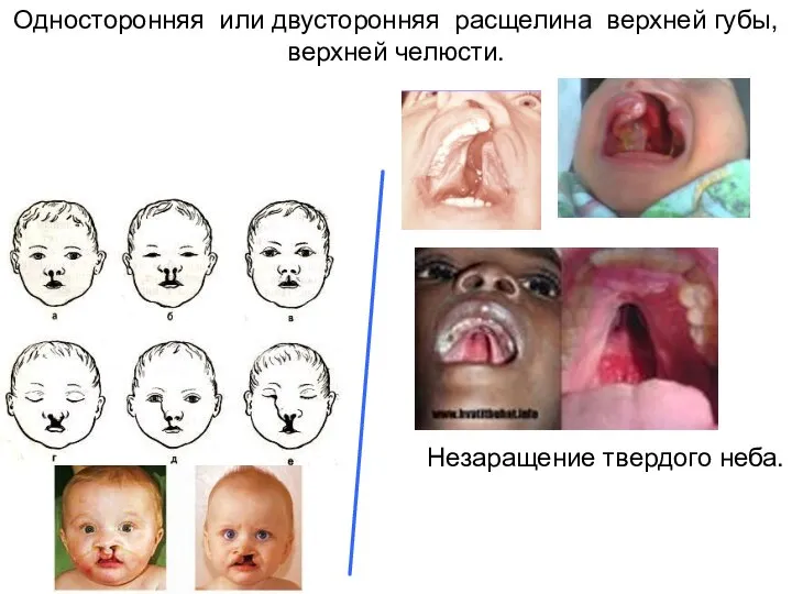 Односторонняя или двусторонняя расщелина верхней губы, верхней челюсти. Незаращение твердого неба.