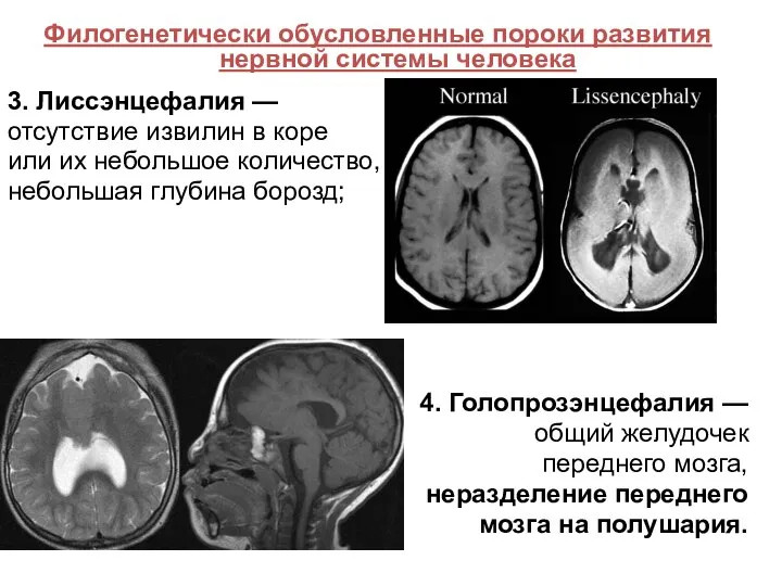 Филогенетически обусловленные пороки развития нервной системы человека 3. Лиссэнцефалия — отсутствие