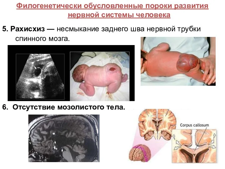 Филогенетически обусловленные пороки развития нервной системы человека 5. Рахисхиз — несмыкание