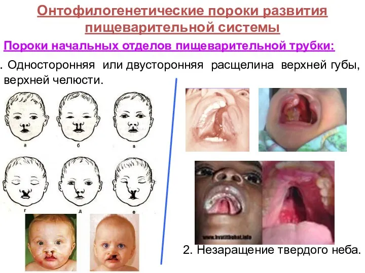 Онтофилогенетические пороки развития пищеварительной системы Пороки начальных отделов пищеварительной трубки: Односторонняя