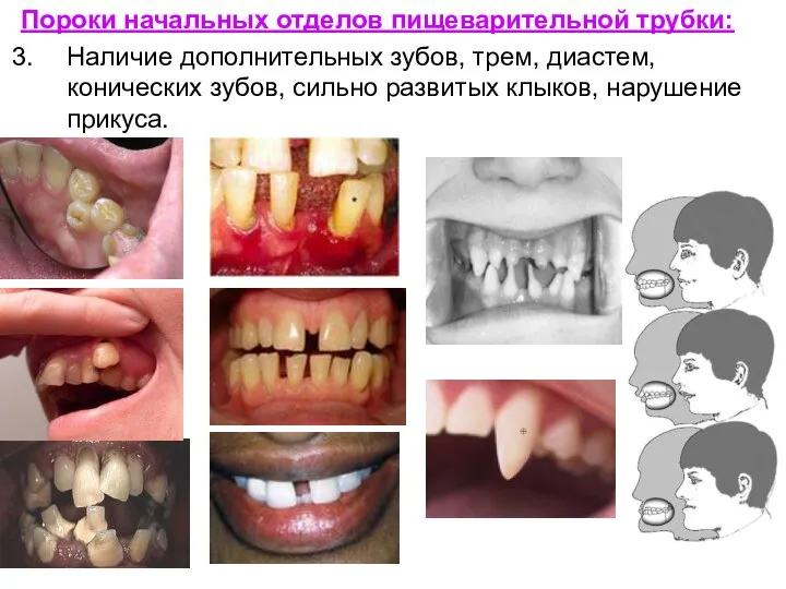 Пороки начальных отделов пищеварительной трубки: Наличие дополнительных зубов, трем, диастем, конических