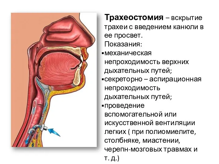 Трахеостомия – вскрытие трахеи с введением канюли в ее просвет. Показания: