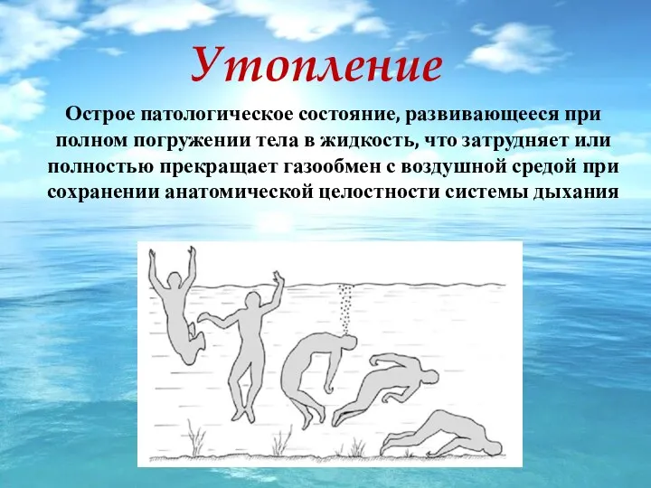 Утопление Острое патологическое состояние, развивающееся при полном погружении тела в жидкость,