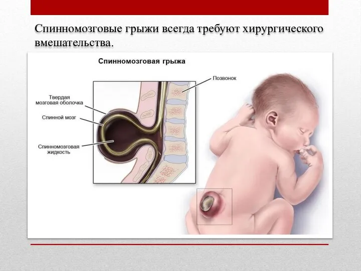 Спинномозговые грыжи всегда требуют хирургического вмешательства.