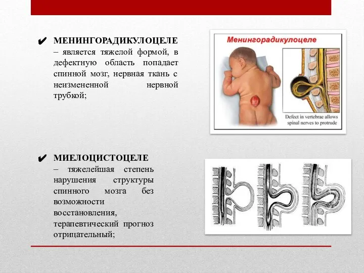 МЕНИНГОРАДИКУЛОЦЕЛЕ – является тяжелой формой, в дефектную область попадает спинной мозг,