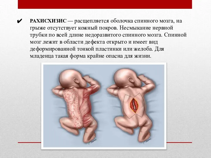 РАХИСХИЗИС — расщепляется оболочка спинного мозга, на грыже отсутствует кожный покров.