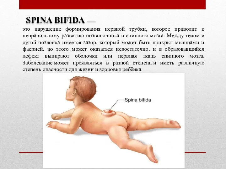 SPINA BIFIDA — это нарушение формирования нервной трубки, которое приводит к