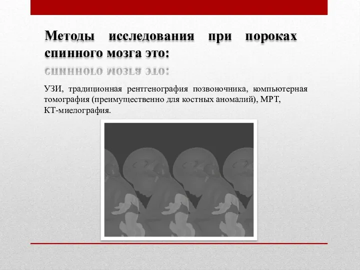 Методы исследования при пороках спинного мозга это: УЗИ, традиционная рентгенография позвоночника,