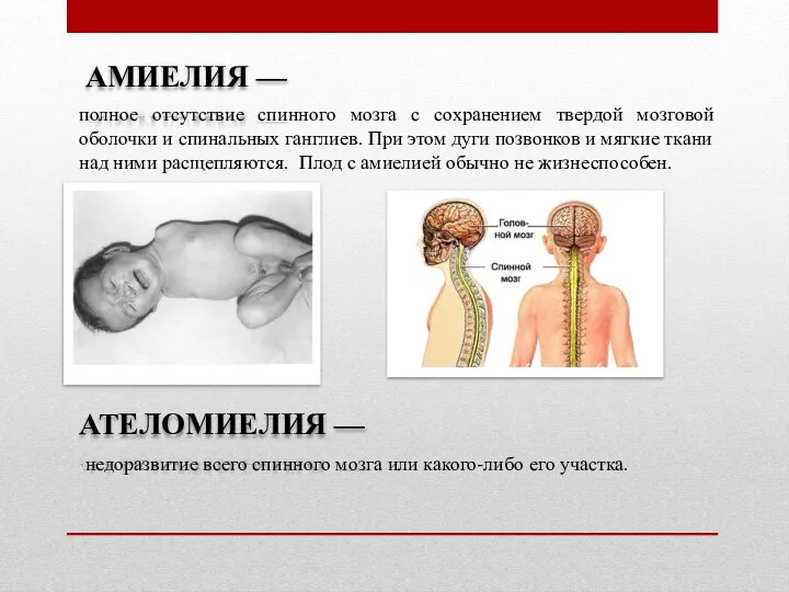 АМИЕЛИЯ — полное отсутствие спинного мозга с сохранением твердой мозговой оболочки