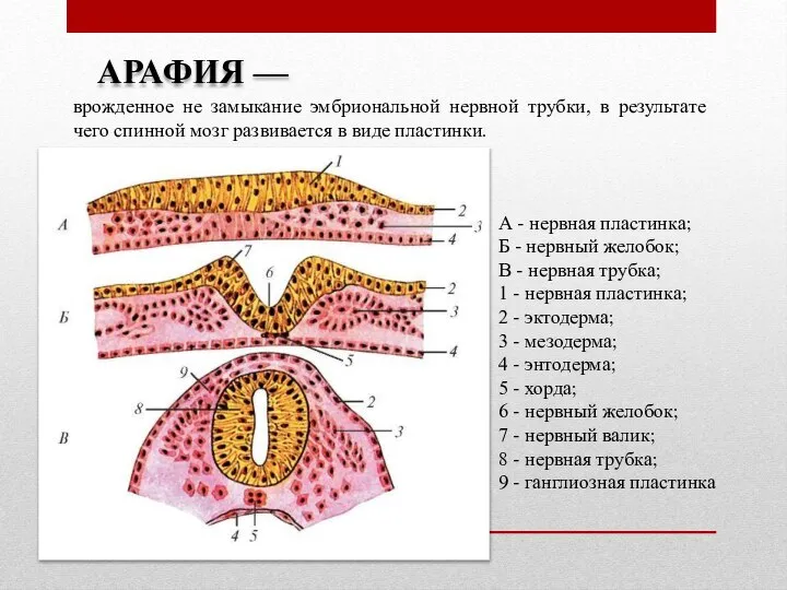 АРАФИЯ — врожденное не замыкание эмбриональной нервной трубки, в результате чего