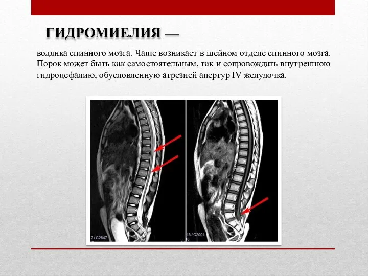 ГИДРОМИЕЛИЯ — водянка спинного мозга. Чаще возникает в шейном отделе спинного