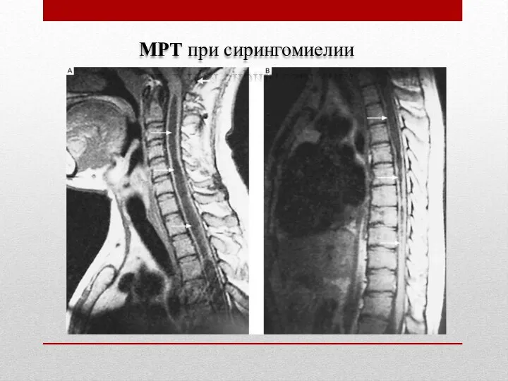 МРТ при сирингомиелии