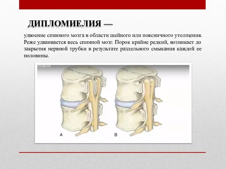 ДИПЛОМИЕЛИЯ — удвоение спинного мозга в области шейного или поясничного утолщения.