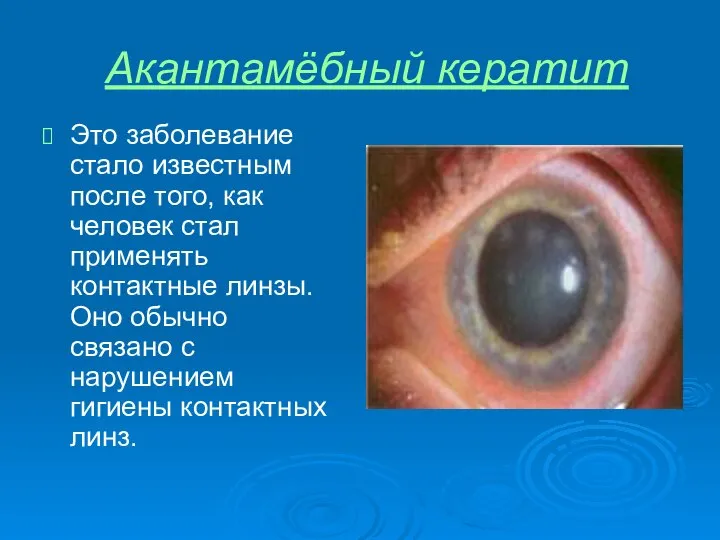 Акантамёбный кератит Это заболевание стало известным после того, как человек стал