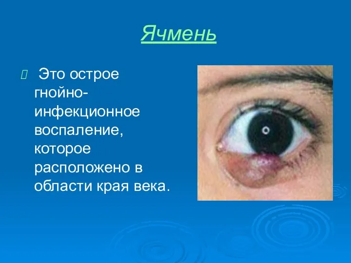 Ячмень Это острое гнойно-инфекционное воспаление, которое расположено в области края века.