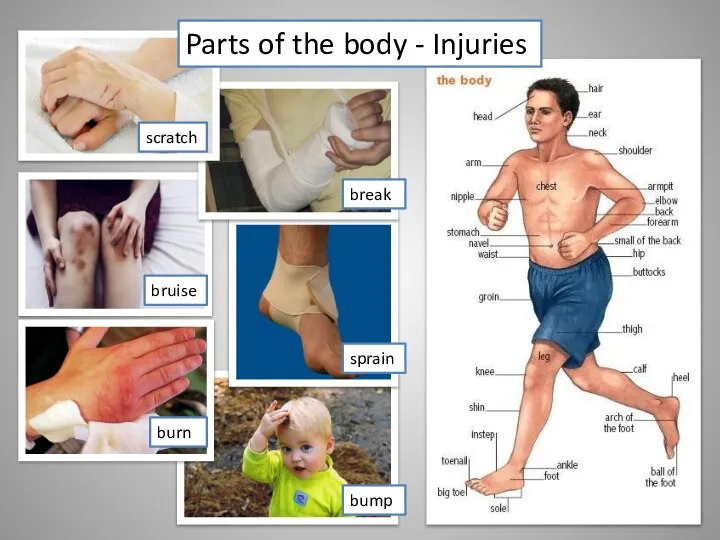 Parts of the body - Injuries scratch bruise burn break sprain bump