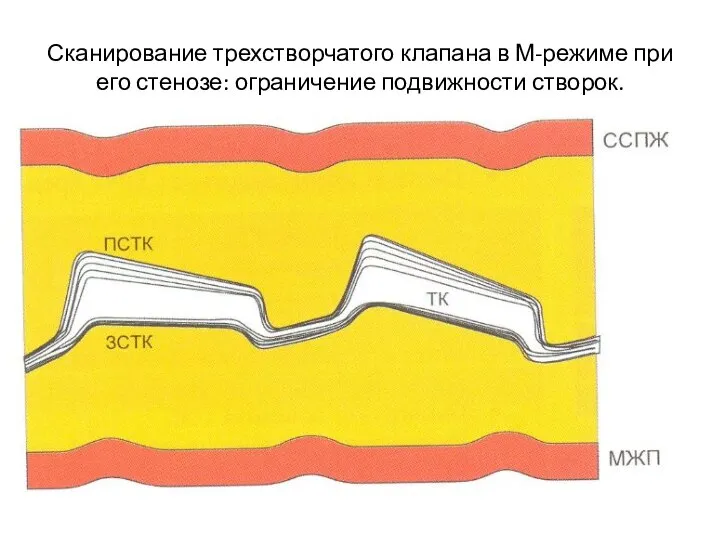 Сканирование трехстворчатого клапана в М-режиме при его стенозе: ограничение подвижности створок.