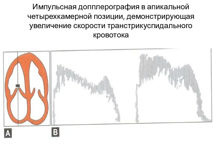 Импульсная допплерография в апикальной четырехкамерной позиции, демонстрирующая увеличение скорости транстрикуспидального кровотока