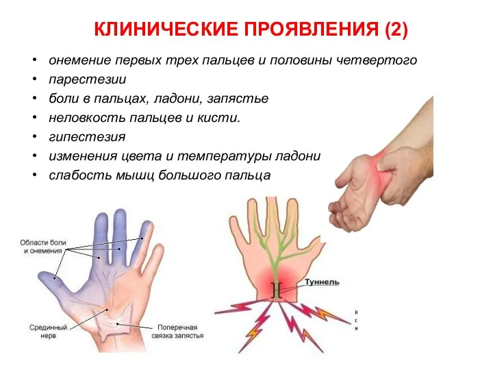 онемение первых трех пальцев и половины четвертого парестезии боли в пальцах,