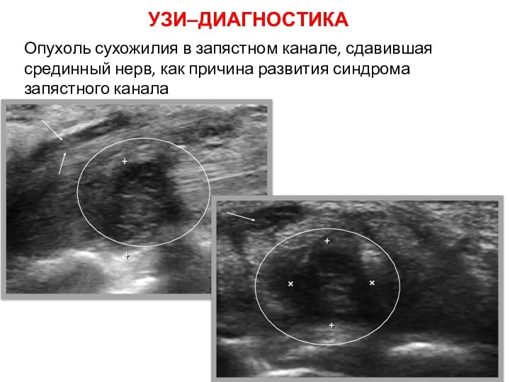 Опухоль сухожилия в запястном канале, сдавившая срединный нерв, как причина развития синдрома запястного канала УЗИ–ДИАГНОСТИКА