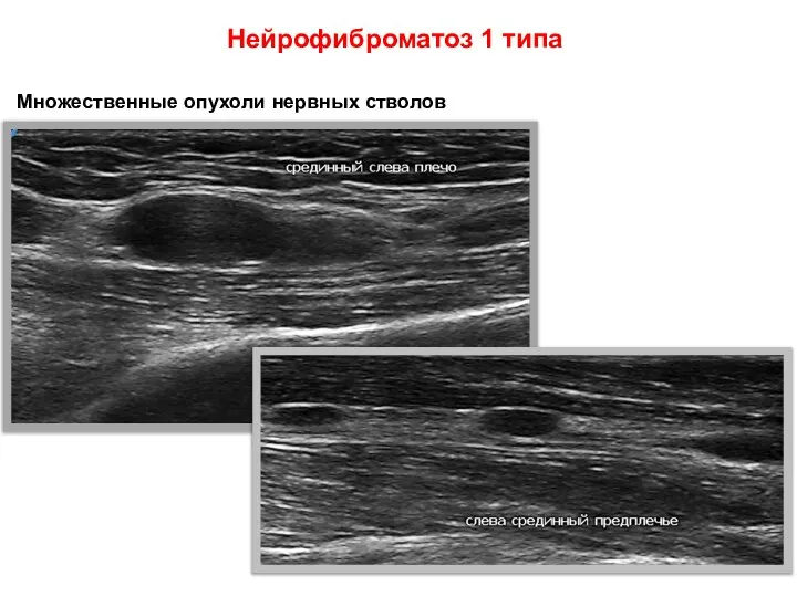 Нейрофиброматоз 1 типа Множественные опухоли нервных стволов