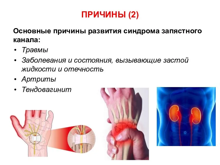 Основные причины развития синдрома запястного канала: Травмы Заболевания и состояния, вызывающие