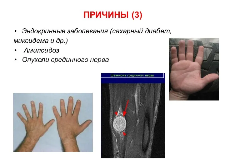 Эндокринные заболевания (сахарный диабет, миксидема и др.) Амилоидоз Опухоли срединного нерва ПРИЧИНЫ (3)