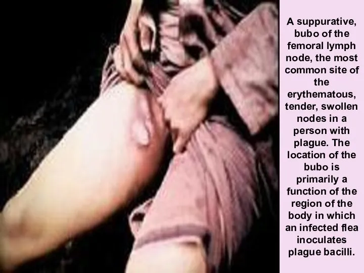 A suppurative, bubo of the femoral lymph node, the most common