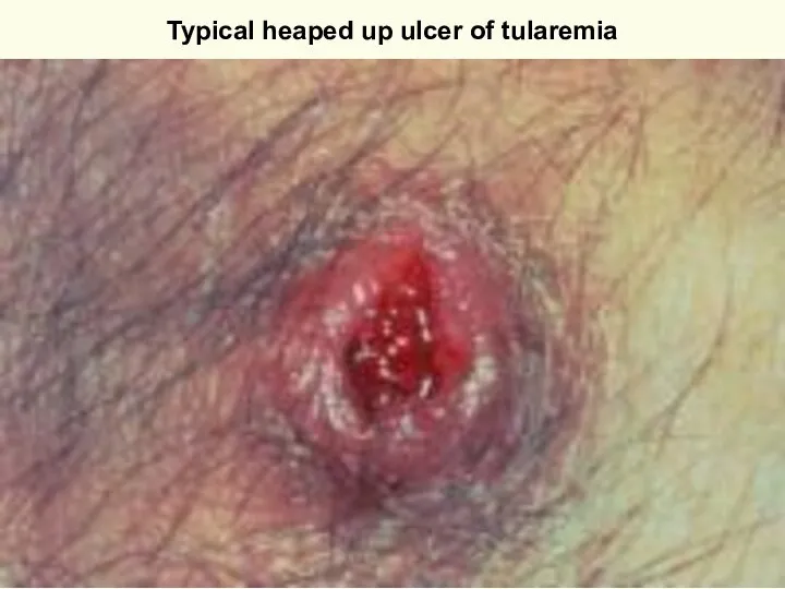 Typical heaped up ulcer of tularemia