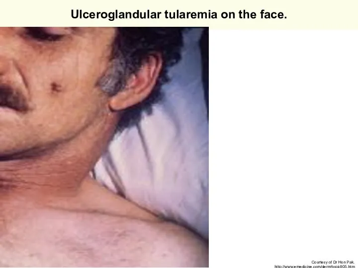 Ulceroglandular tularemia on the face. Courtesy of Dr Hon Pak. http://www.emedicine.com/derm/topic905.htm