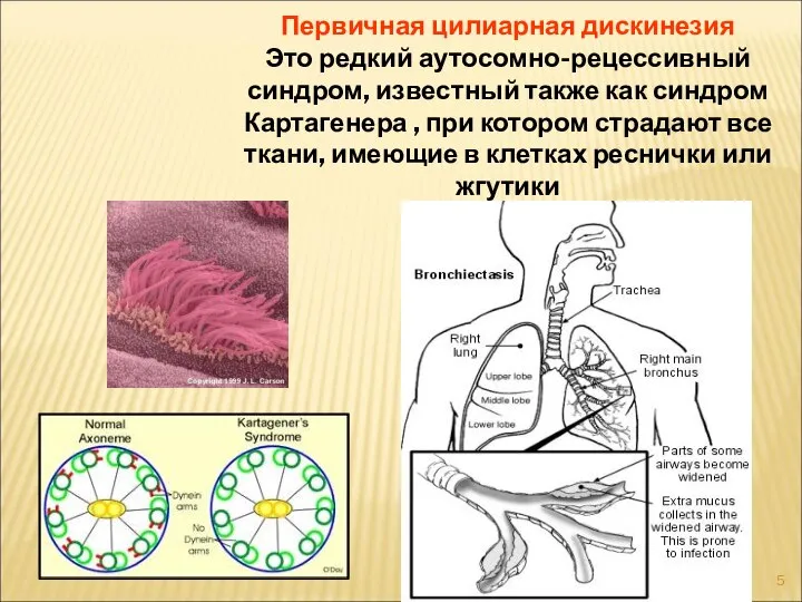 Первичная цилиарная дискинезия Это редкий аутосомно-рецессивный синдром, известный также как синдром