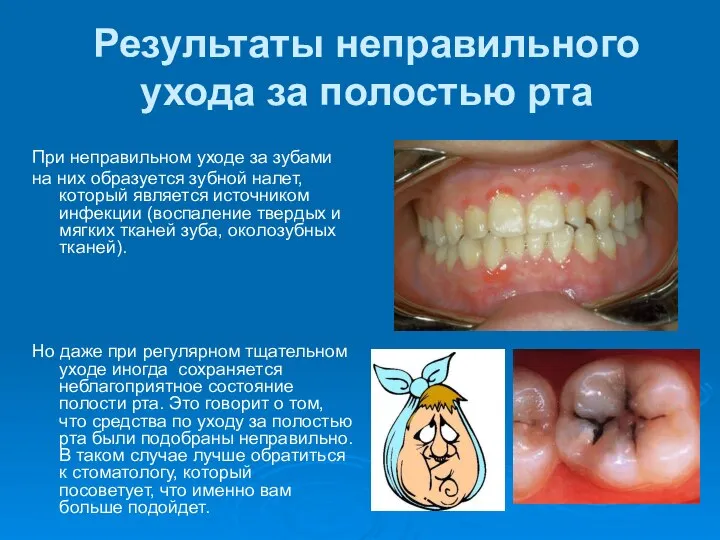 Результаты неправильного ухода за полостью рта При неправильном уходе за зубами