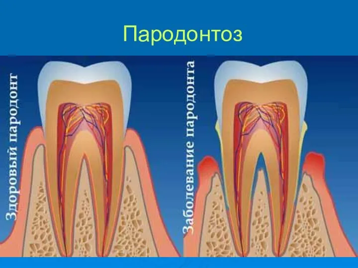 Пародонтоз