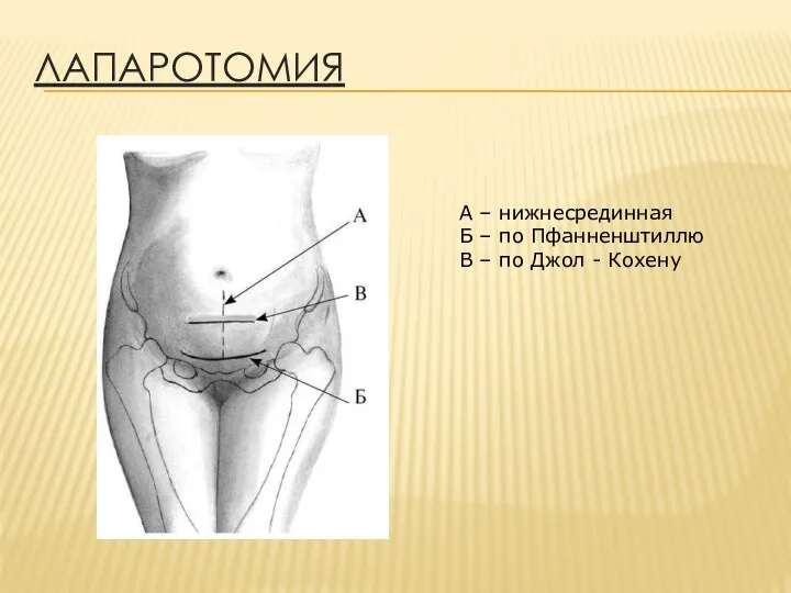 ЛАПАРОТОМИЯ А – нижнесрединная Б – по Пфанненштиллю В – по Джол - Кохену