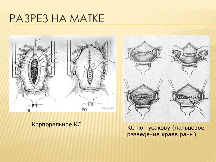 РАЗРЕЗ НА МАТКЕ Корпоральное КС КС по Гусакову (пальцевое разведение краев раны)