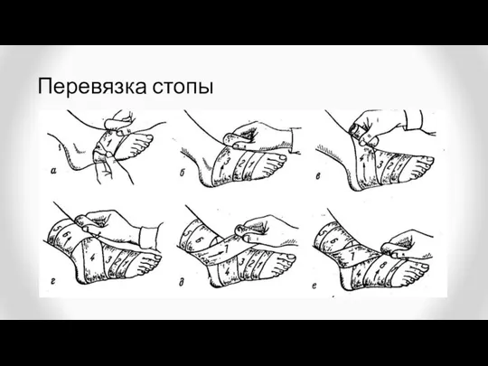 Перевязка стопы