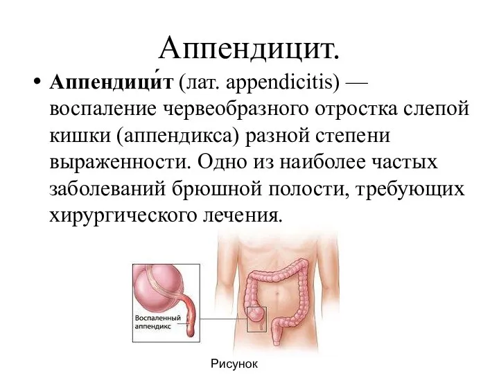 Аппендицит. Аппендици́т (лат. appendicitis) — воспаление червеобразного отростка слепой кишки (аппендикса)