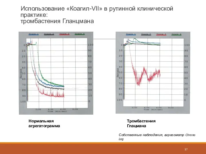 Использование «Коагил-VII» в рутинной клинической практике: тромбастения Гланцмана Собственные наблюдения, агрегометр