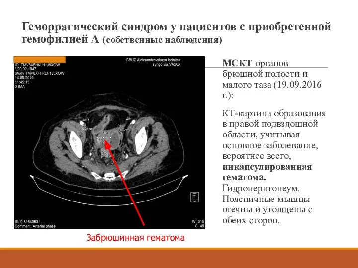 Геморрагический синдром у пациентов с приобретенной гемофилией А (собственные наблюдения) МСКТ