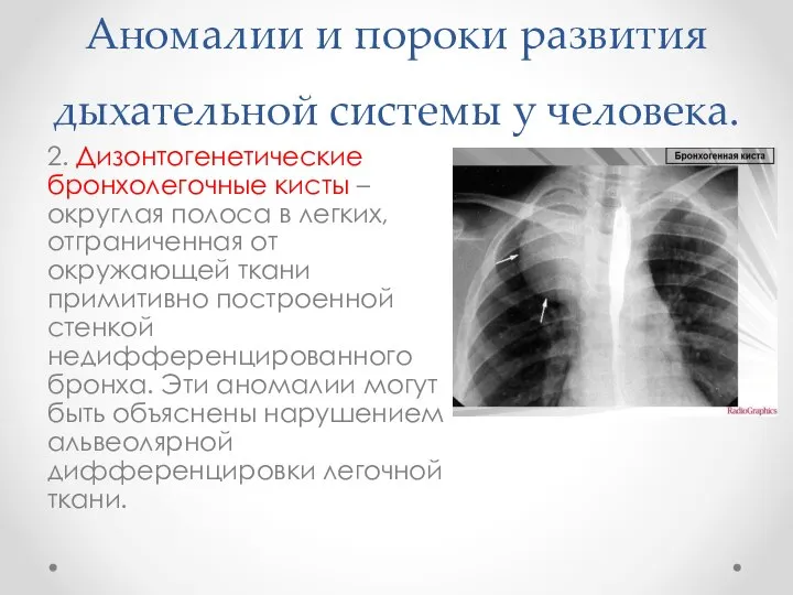 Аномалии и пороки развития дыхательной системы у человека. 2. Дизонтогенетические бронхолегочные
