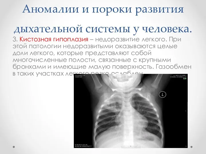 Аномалии и пороки развития дыхательной системы у человека. 3. Кистозная гипоплазия