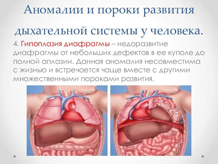 Аномалии и пороки развития дыхательной системы у человека. 4. Гипоплазия диафрагмы