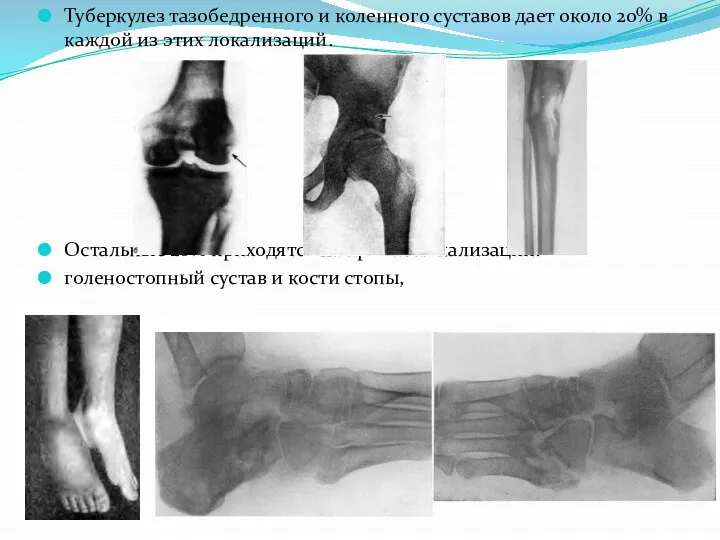 Туберкулез тазобедренного и коленного суставов дает около 20% в каждой из