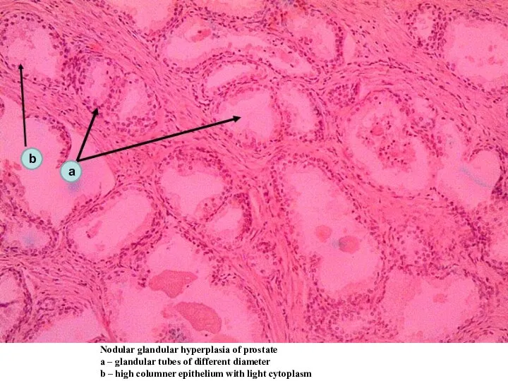 Nodular glandular hyperplasia of prostate а – glandular tubes of different