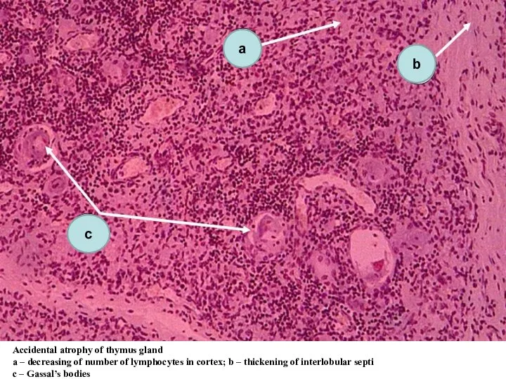 Accidental atrophy of thymus gland а – decreasing of number of