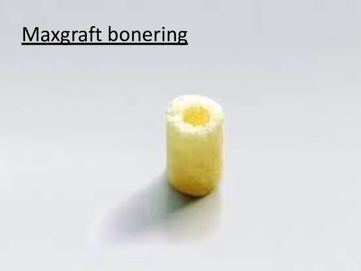 Maxgraft bonering