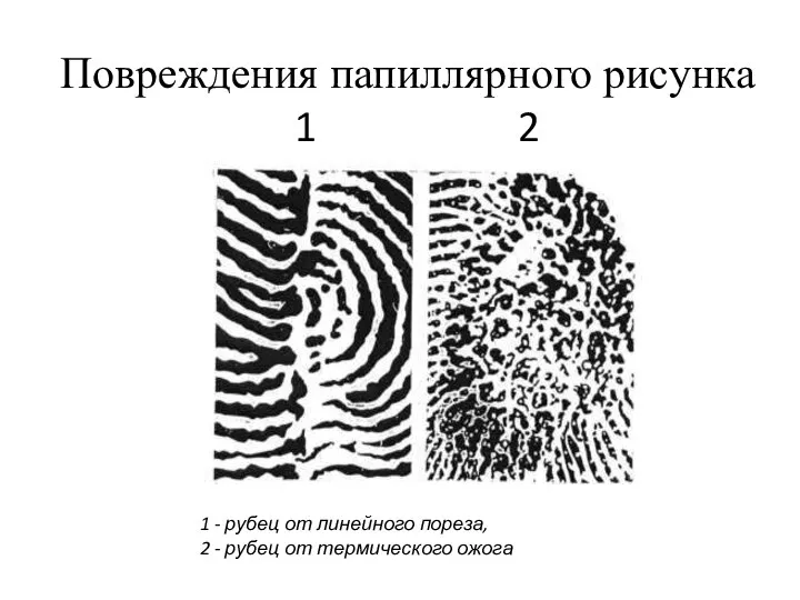 Повреждения папиллярного рисунка 1 2 1 - рубец от линейного пореза,