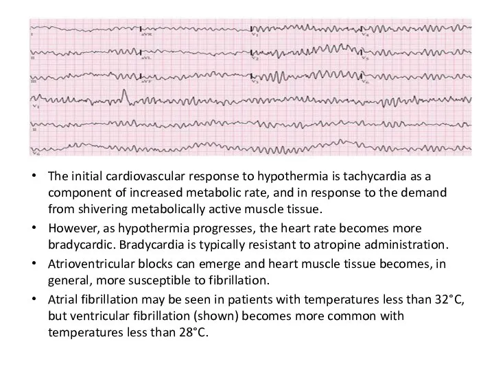 The initial cardiovascular response to hypothermia is tachycardia as a component