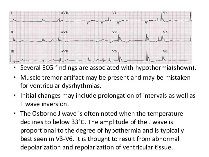 Several ECG findings are associated with hypothermia(shown). Muscle tremor artifact may