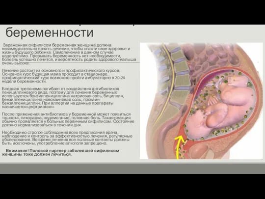 Лечение сифилиса при беременности Зараженная сифилисом беременная женщина должна незамедлительно начать